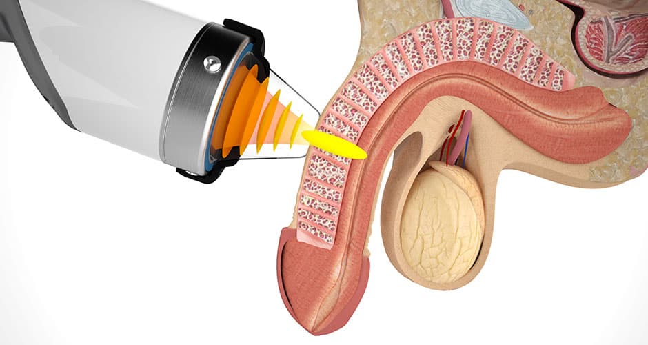 Terapia onde d’urto impotenza