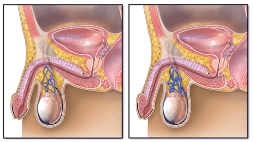 Varicocele sintomi