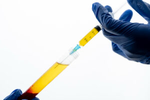 Prp per l'induratio penis plastica